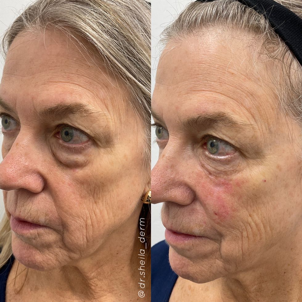 facial balancing before and after, courtesy of dr sheila farhang