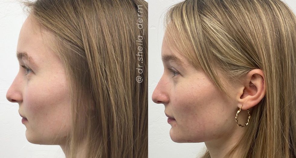 facial balancing before and after, courtesy of dr sheila farhang